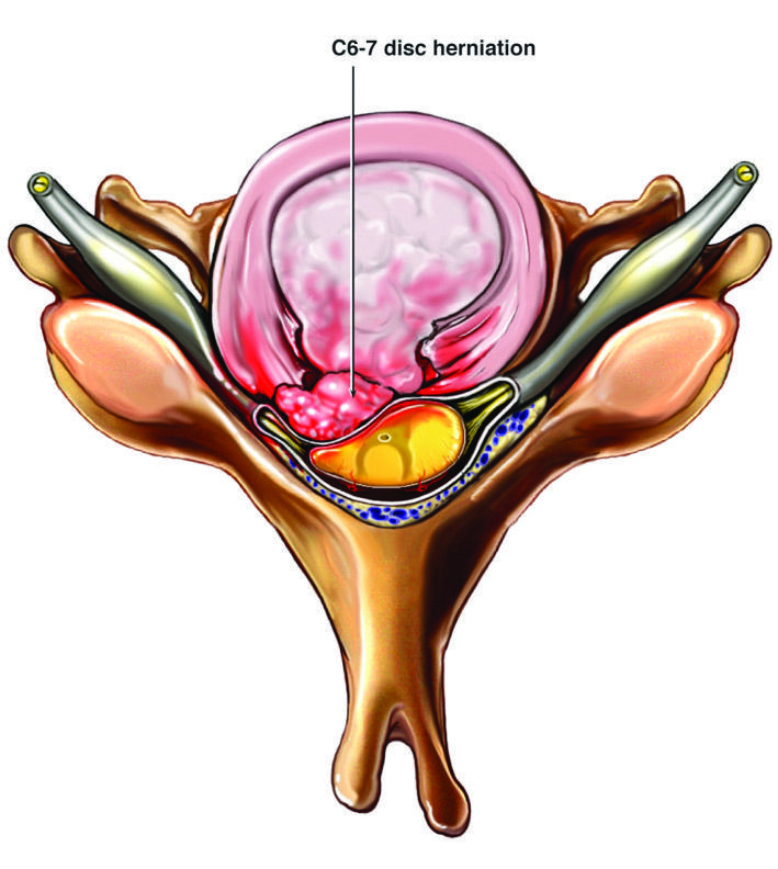 Herniated Disc vs Bulging Disc
