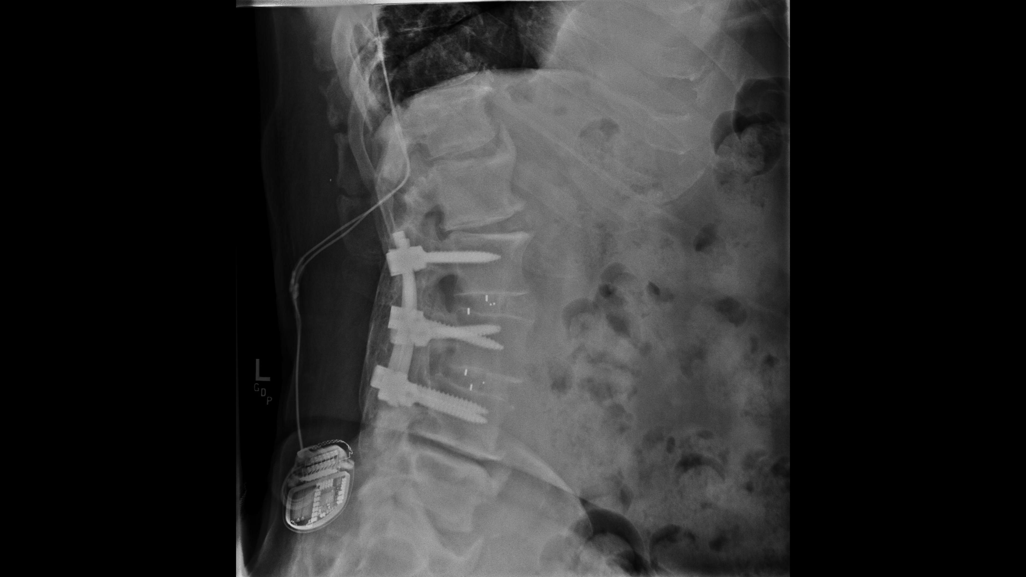 Lateral lumbar spine X-ray showing multi-level pedicle screw and rod fusion with an implanted spinal cord stimulator