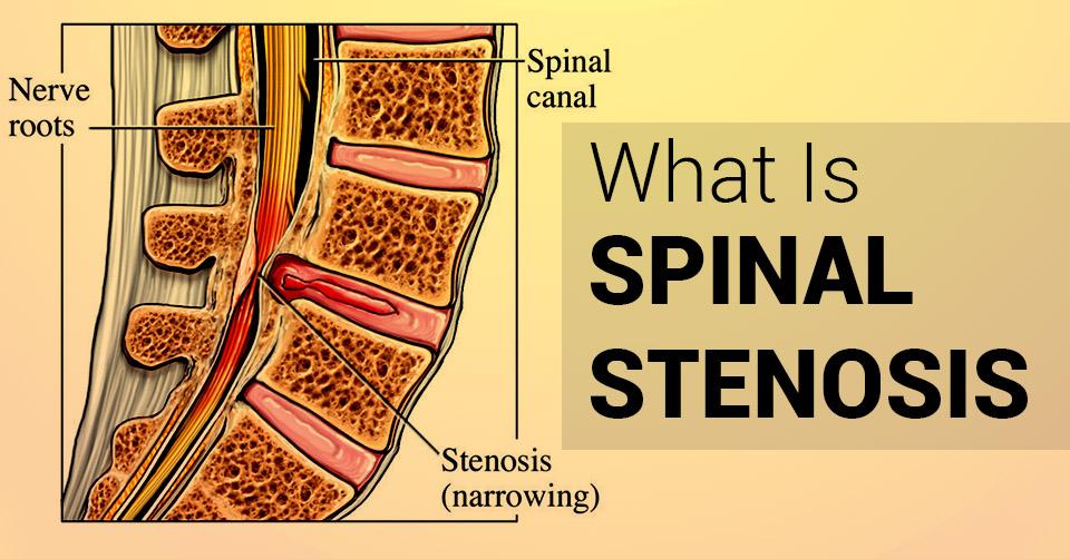 Spinal Stenosis Causes and Treatment