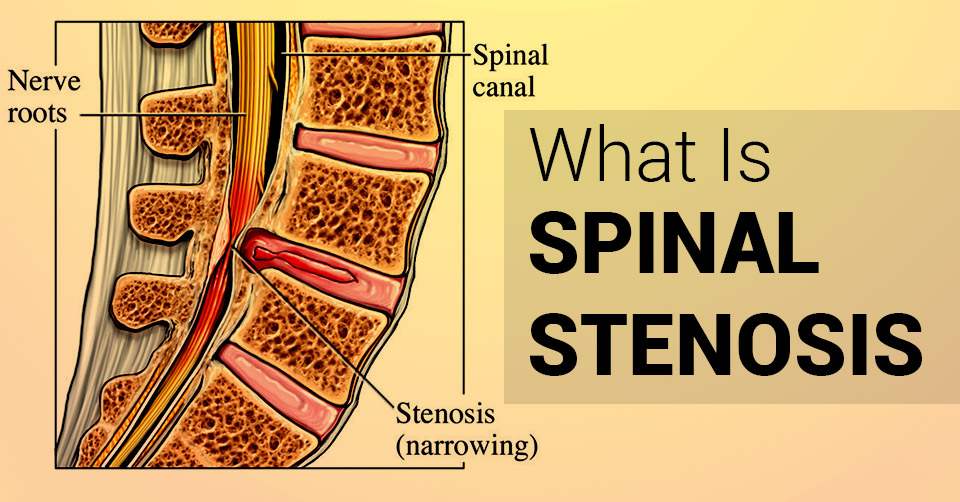 bpc-157 spinal stenosis Treatment & Diagnosis The DRS Protocol™ For Spinal