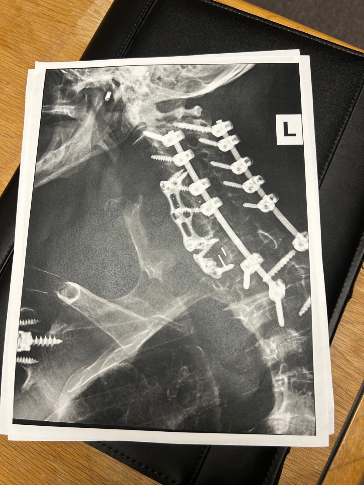 Lateral neck X-ray showing a cervical spinal fusion with a front plate and rear screws and rods