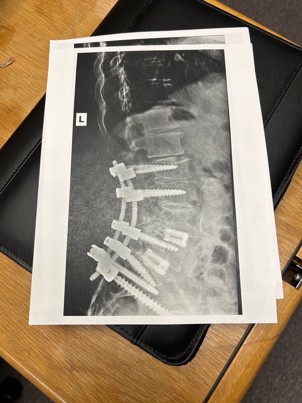 Lateral lumbar spine X-ray showing a long fusion with pedicle screws and rods extending to the base of the spine, with interbody cages