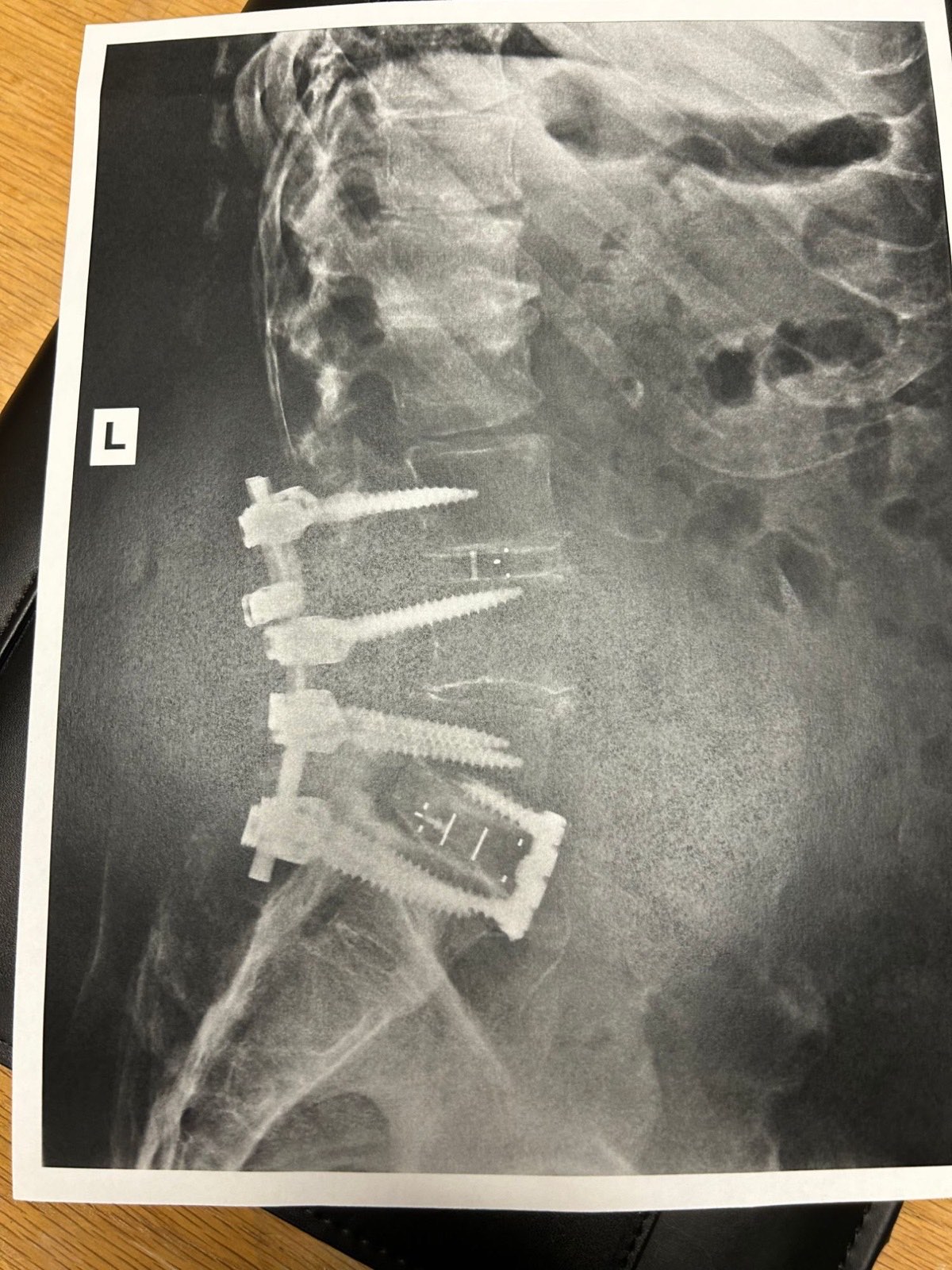 Lateral lumbar spine X-ray showing a multi-level spinal fusion with pedicle screws, rods, and an interbody cage
