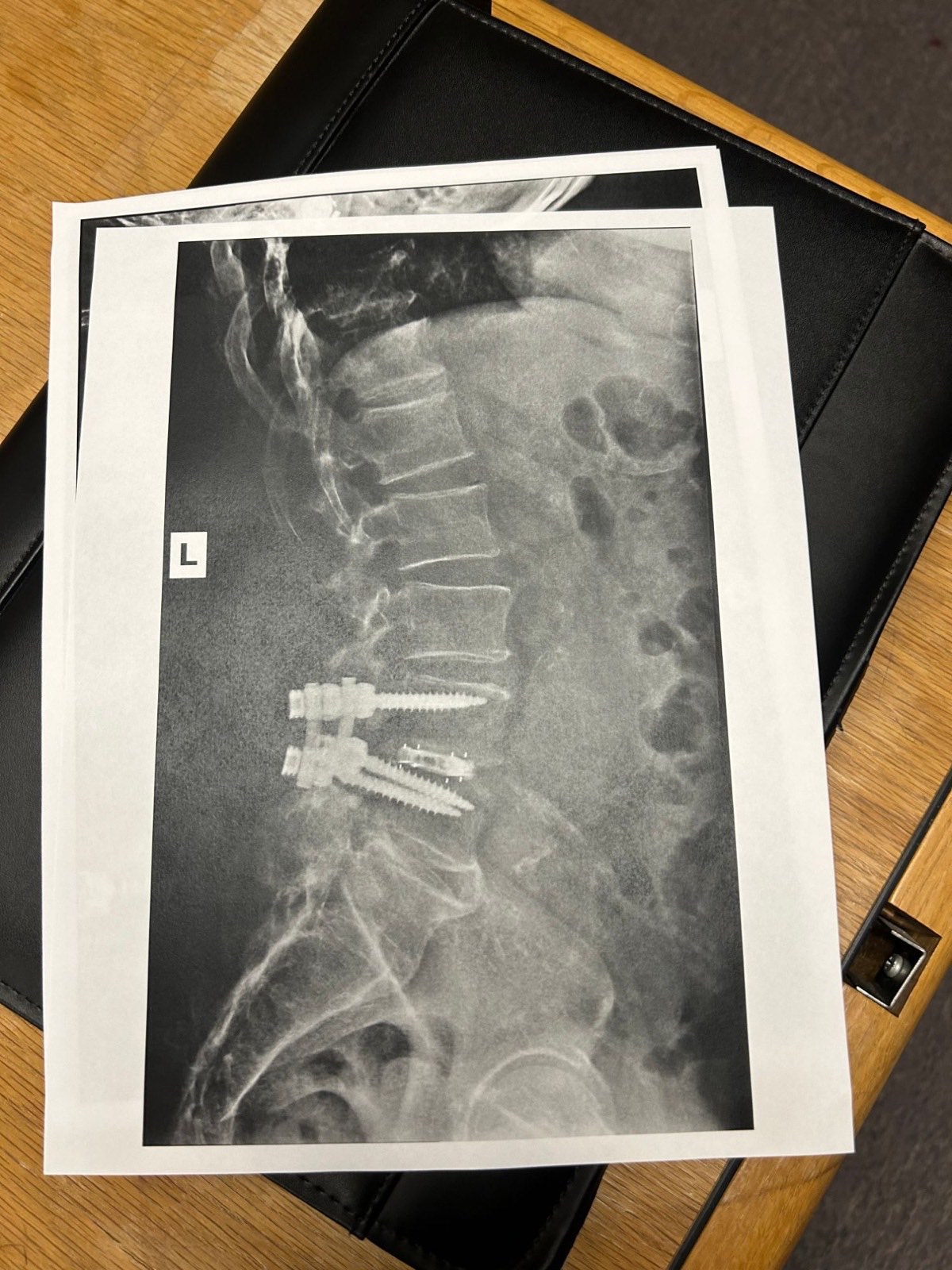 Lateral lumbar spine X-ray showing a single-level spinal fusion with pedicle screws and an interbody spacer