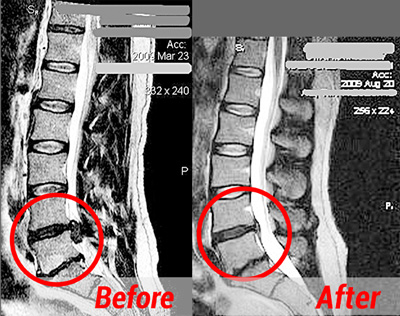 Herniated Disc Treatment MRI Before After