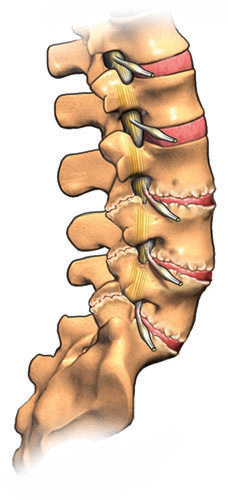 Degenerative Disc Disease