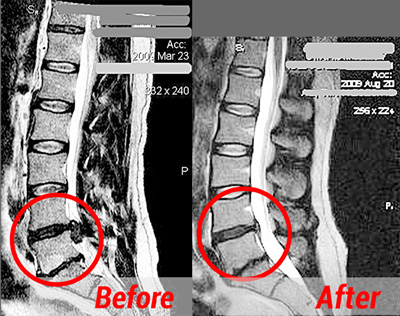 herniated disc treatment fort wayne