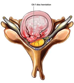 causes of a herniated disc