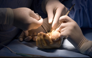 carpal tunnel surgery fort wayne
